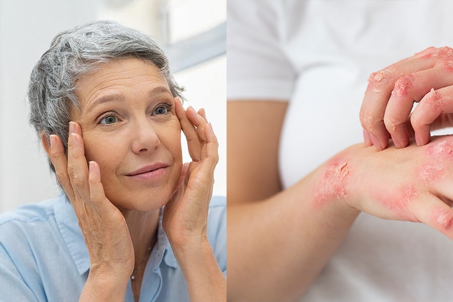 CBD Oil for other Skin Problems Aging and Wrinkles Eczema and Psoriasis